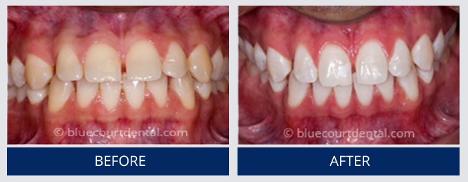 Whitening Case