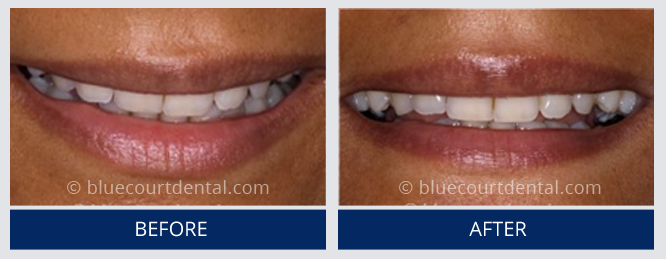 Inman Aligner Case