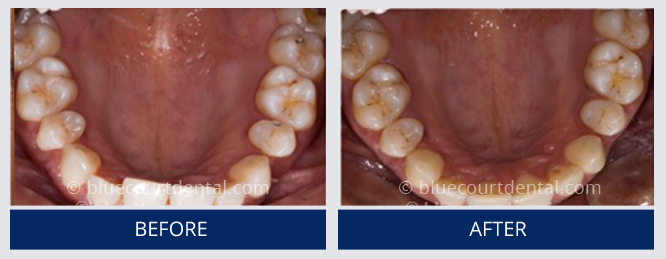 Inman Aligner Case