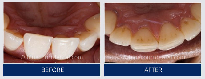 Inman Aligner Case