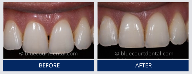 Inman Aligner Case