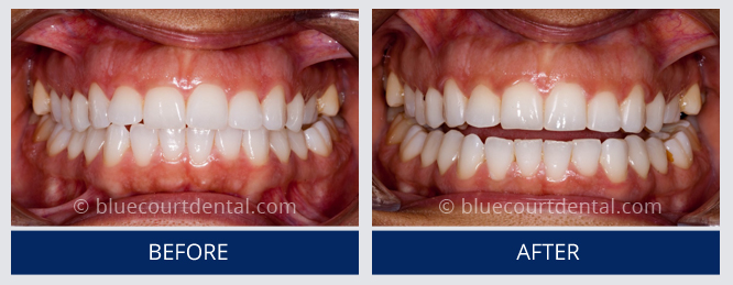 Inman Aligner Case