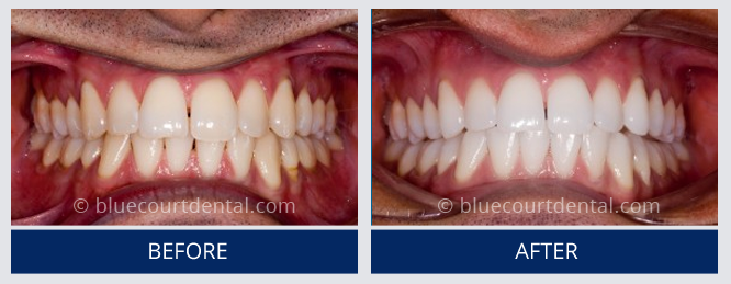 Whitening Case