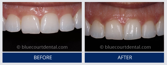 Inman Aligner Case