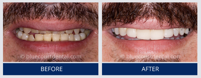 Mini Smile Makeover Case