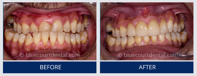 Mini Smile Makeover Case