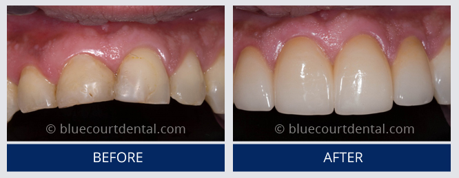 Mini Smile Makeover Case