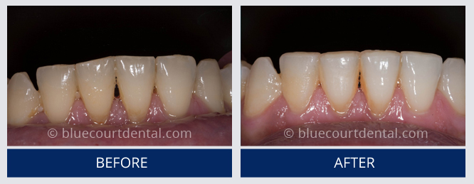 Mini Smile Makeover Case