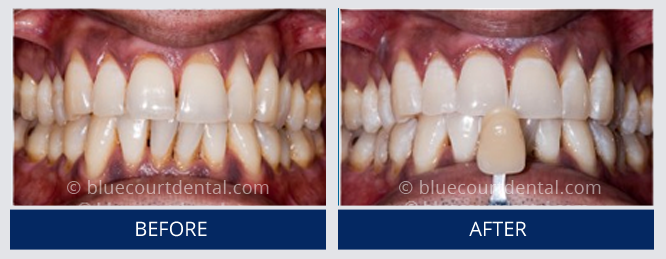 Whitening Case