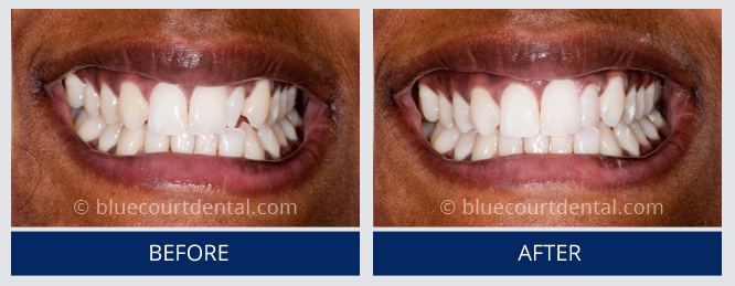 Composite Bonding Case