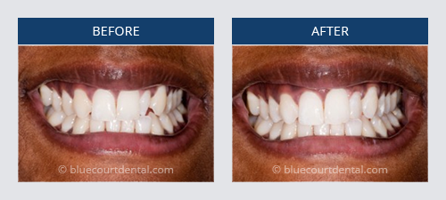 straightening crooked tooth with veneers