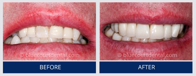 Mini Smile Makeover Case