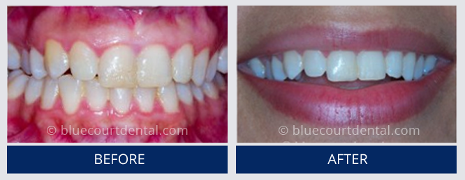 Whitening Case