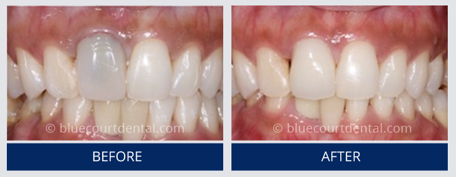 Internal Bleaching Case