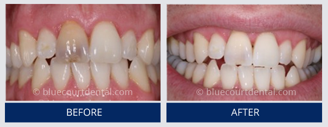 Internal Bleaching Case