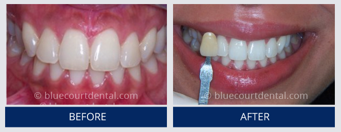 Whitening Case