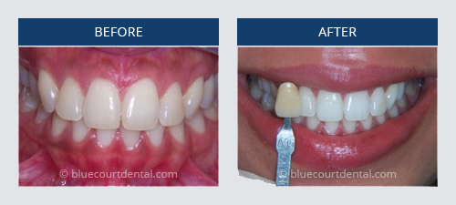 Zirconia Crown Color Chart