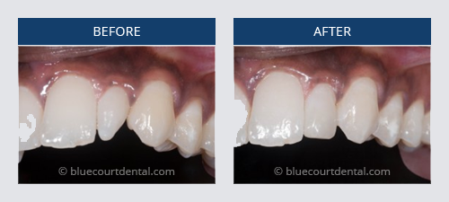 Dental bonding to correct mild crooked teeth
