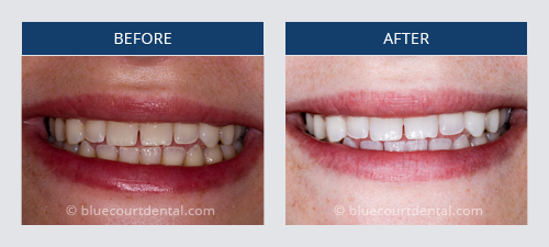 Whitening Case