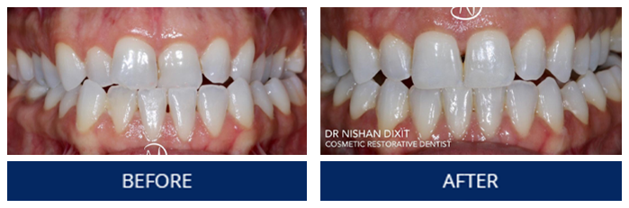 Invisalign Case