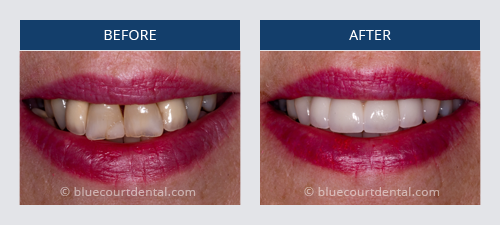 Full Smile Makeover