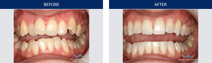 six-month-smiles