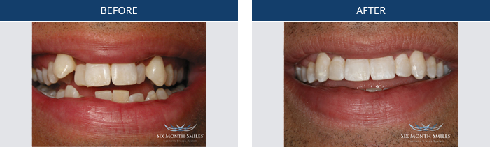 six-month-smiles