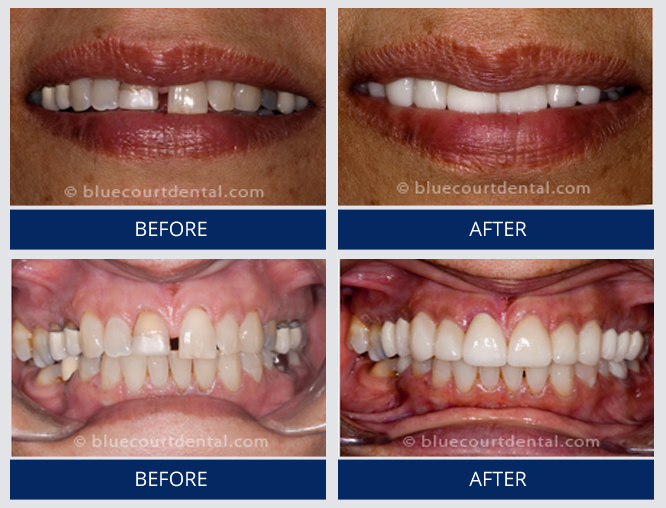 Full Smile Makeover