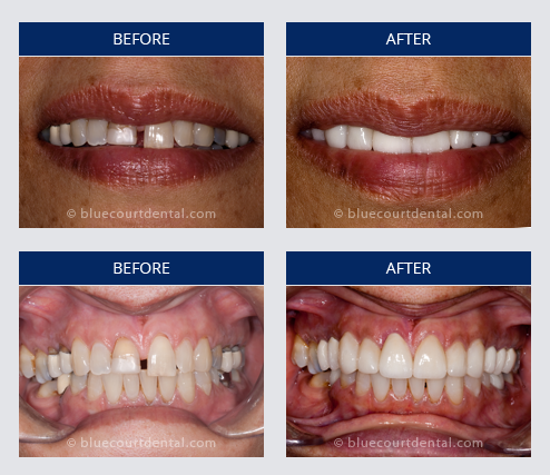 Full Smile Makeover