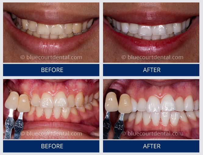 Whitening Case