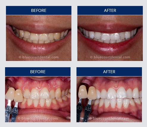Whitening Case