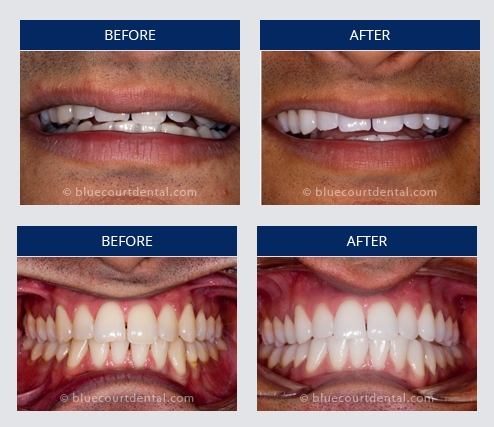 Whitening Case