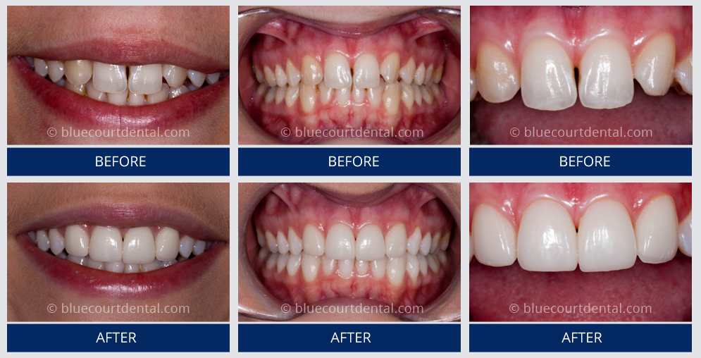 Veneers Case