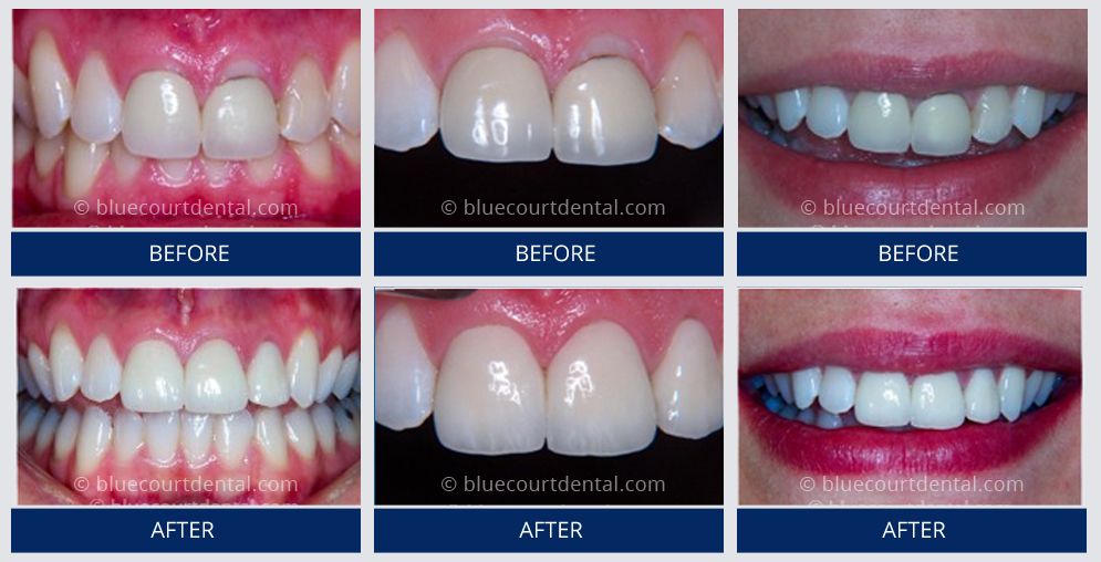 Veneers Case