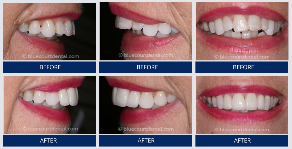 Veneers Case