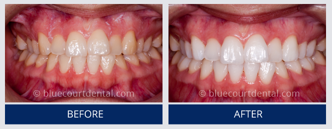 Whitening Case