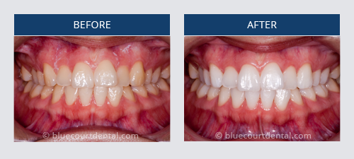 Whitening Case