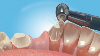 Dental Bridges