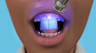 Veneers