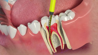 Root Canal Treatment